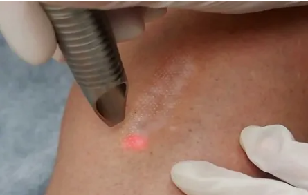 Laser Resurfacing - Laser untuk Menghilangkan Bekas Luka