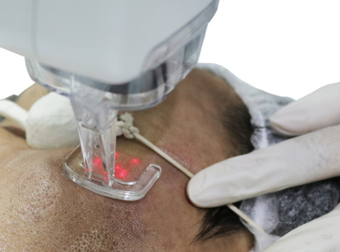Scar Laser Treatment - Laser untuk Menghilangkan Bekas Luka